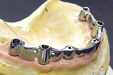 インプラント リーゲル