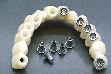 インプラント 上部構造