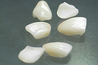 ラミネートベニア