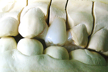 ジルコニア インレー