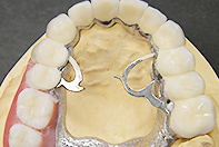 上下顎プッシュ式 リーゲルテレスコープ