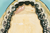 下顎3ピース フリクションピンテレスコープ