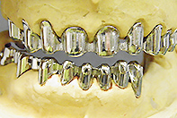 上下顎<br>リーゲルテレスコープ