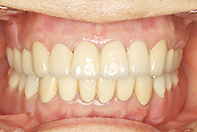 上顎リーゲルテレスコープ 下顎フリクションピン テレスコープ