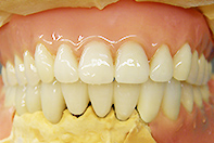 上顎コーピングタイプレジリエンツ内冠下顎CSPリーゲルテレスコープ