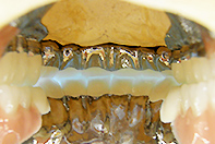 上下顎リーゲルテレスコープ