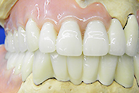 上顎レジリエンツ下顎リーゲルテレスコープ