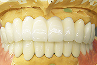 上顎内冠1次固定下顎2ピースリーゲルテレスコープ