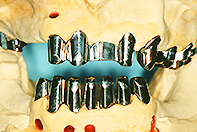 上顎リーゲル下顎コーヌスフリクションピンテレスコープ