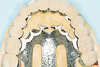 上下顎リーゲルテレスコープ