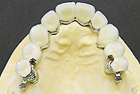 上顎リーゲル下顎フリクションピンテレスコープ