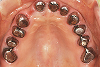 上顎 コーヌステレスコープ