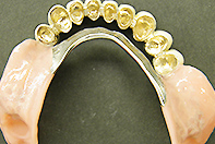 下顎PGAコーヌス 上顎PGAブリッジ