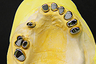 中間、遊離端欠損 コーヌステレスコープ