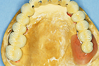 上顎単独支台冠2次固定 リーゲルテレスコープ