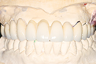 上顎中間遊離端欠損MB リーゲルテレスコープ