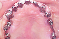 上顎天然歯+両側インプラント リーゲルテレスコープ