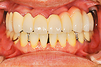 上顎チタン リーゲルテレスコープ （内冠1次固定）