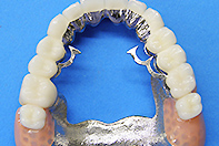 上顎全支台歯1次固定リーゲルテレスコープ