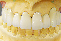 上顎両側リーゲルテレスコープ（1歯残根使用)