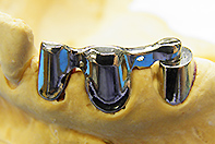 下顎リーゲル（残存歯の有効活用）