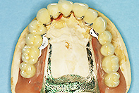 上顎単独支台冠＋トーションバーリーゲルテレスコープ