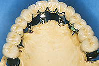 上顎単独支台冠ＭＢリーゲルテレスコープ