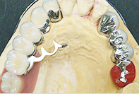 遊離端リーゲルテレスコープ