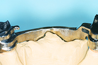 上顎CSP+ミリングバー リーゲルテレスコープ