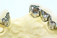 上顎前歯ミリング＋ フリクションピン テレスコープ（床2形態）