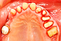 上顎リーゲル 下顎インプラント
