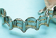 上顎前歯ミリング＋フリクションピン片顎欠損テレスコープ