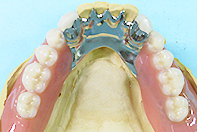 下顎ミリング＋フリクションピンテレスコープ(床2形態）