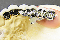 片側Co-Cr,CSPリーゲルテレスコープ