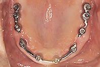 上下顎インプラント サブスーパーストラクチャー リーゲルテレスコープ