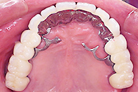 上顎天然歯+中間欠損部 インプラントリーゲルテレスコープ