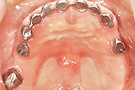 上顎リーゲル+ インプラントテレスコープ