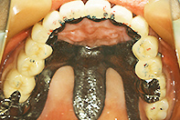 上顎中間遊離端欠損 マグネットテレスコープ