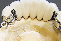 下顎Co-CrZL アタッチメント