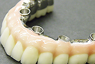 下顎チタンベース使用 ボーンアンカーフルブリッジ