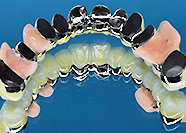 コーヌス　チタンコーヌステレスコープ