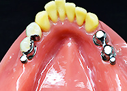 CSPリーゲルテレスコープ　CSP+チタン内外冠リーゲルテレスコープ