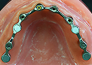 インプラント　マグネット可撤式フルチタン上部構造(3iEXコニカル）