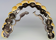 インプラント　天然歯+インプラント(Synocta)リーゲル上部構造