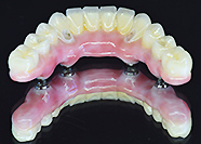 インプラント　iベース使用ZRスクリューリテイン上部構造(3i,EX)