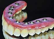 インプラント　チタンベース組み込みZRフル上部構造