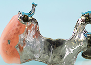 チタンパラレルミリングテレスコープ