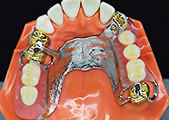 RPIパーシャル鋳造床　RPI Co-Cr床