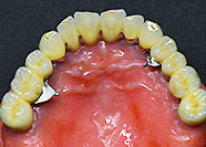 リーゲルテレスコープ　Co-Cr単独支台歯リーゲルテレスコーフ