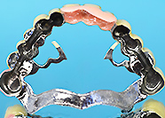 リーゲルテレスコープ　チタンプッシュ式内冠連結リーゲルテレスコーフ